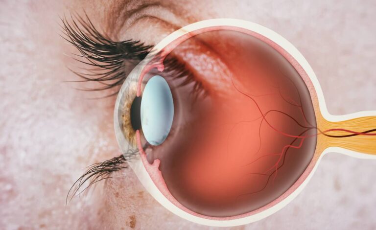 perioperativevisionproblems
