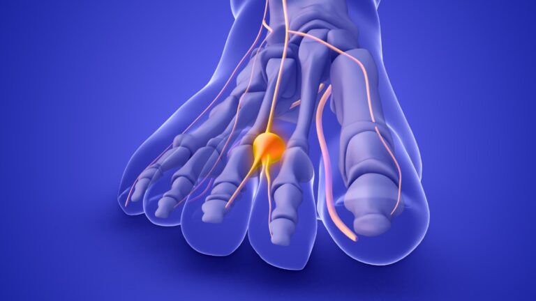 Nerve Blocks for Podiatric Surgery